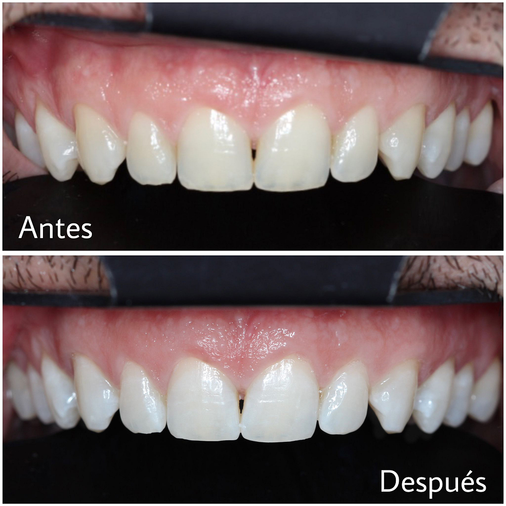 Blanqueamiento Dental en Marcos Segura Dental y Estética
