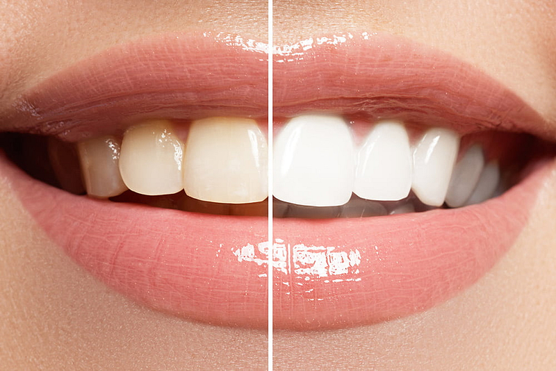 Blanqueamiento Dental en Alicante