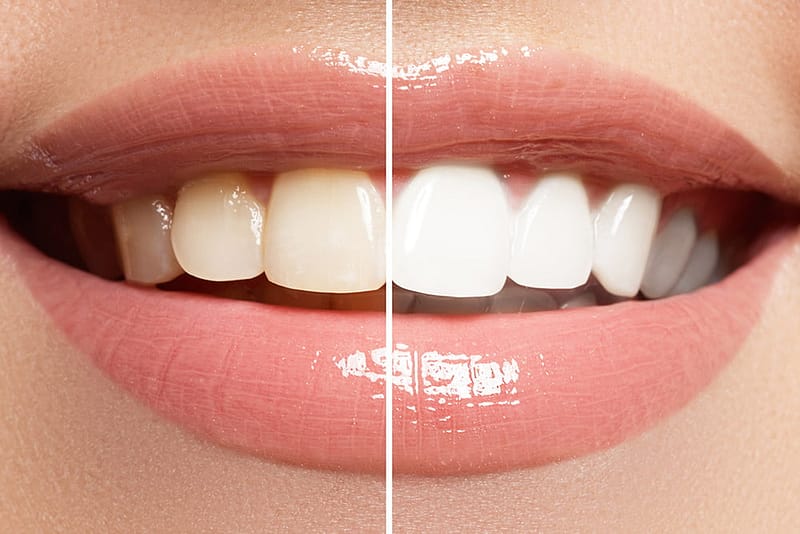 Blanqueamiento Dental en Alicante